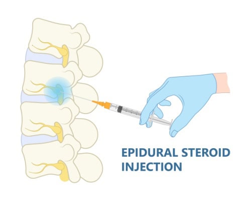 illustration of epidural steroid injection.